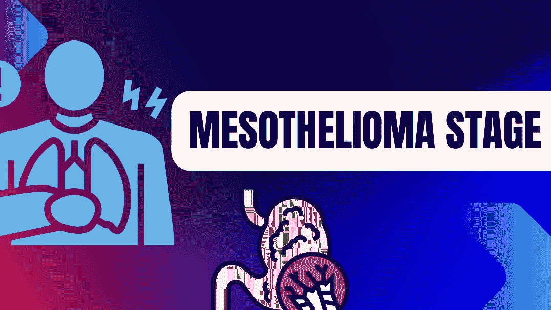 Mesothelioma stage 1